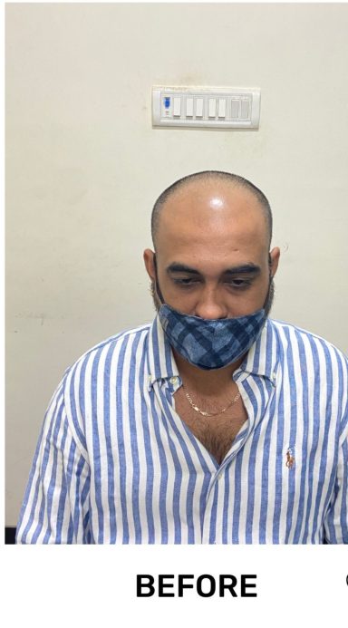 Hair transplant in India