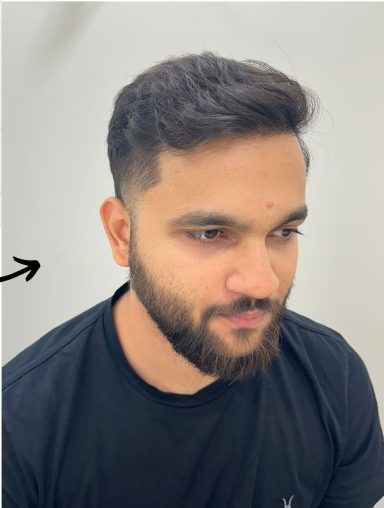 Best hair transplant in India