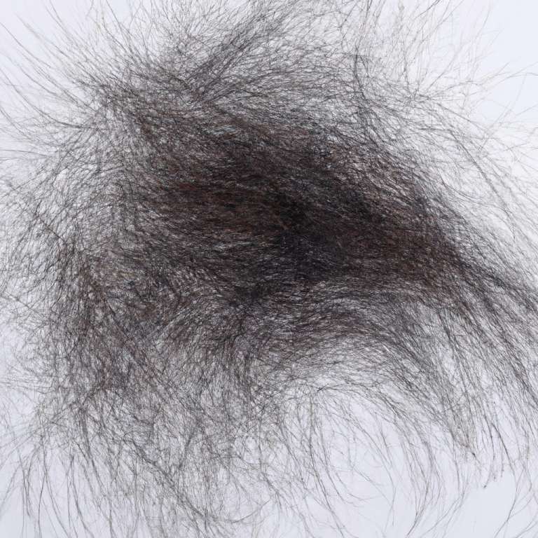 Hair transplant India