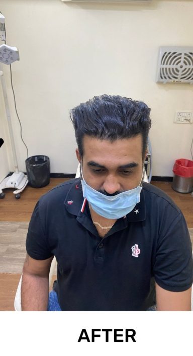 Hair transplant treatment in India